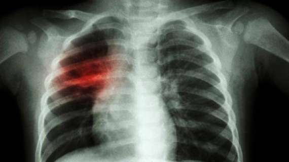 Coronavirus / L'allarme da Bergamo: "Almeno 1800 trentenni con polmonite"