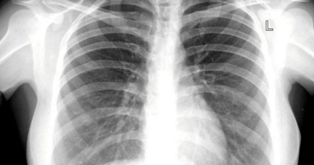 NEWS | Tubercolosi, aumentano i casi: il Lazio tra le regioni più colpite