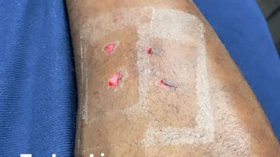 Balotelli mostra i segni dei tacchetti dopo il rosso e polemizza su Instagram