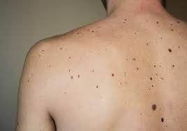 In campo l’Associazione Umbra No al Melanoma di Perugia: prevenzione tutto l'anno, con il sole che fa male anche in città