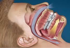 Uno su quattro è affetto da apnee notturne e la quota del pazienti è in crescita: se ne è parlato a Foligno